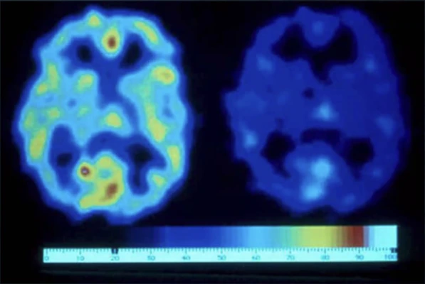 Two brain scans comparing blood flow during normal breathing and during hyperventilation.